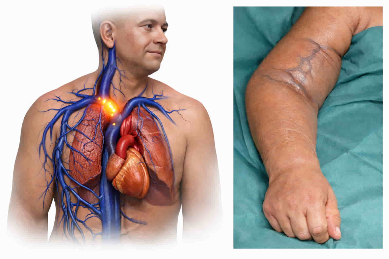 A medical diagram illustrating symptoms of central vein blockage, specifically showing a swollen arm and distended veins due to venous obstruction, available for treatment in Hyderabad by Dr Ram Kishore Gujarala.