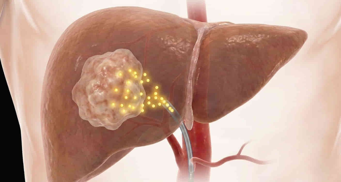 IR4Ubyram Dr Ram Kishore Gujarala Interventional Radiologist India Hyderabad Chennai Y90 Radio Embolization