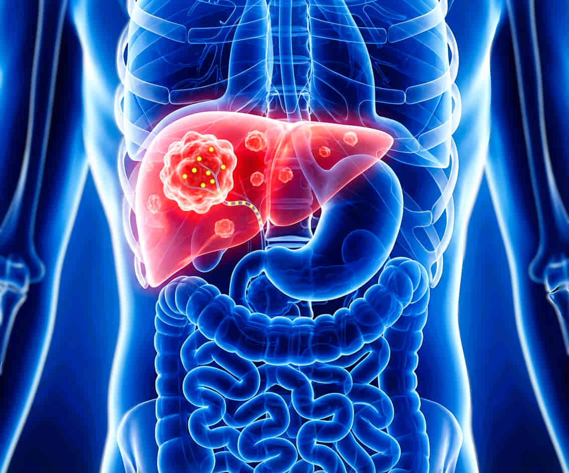 dr-ram-kishore-radioembolization-hyderabad