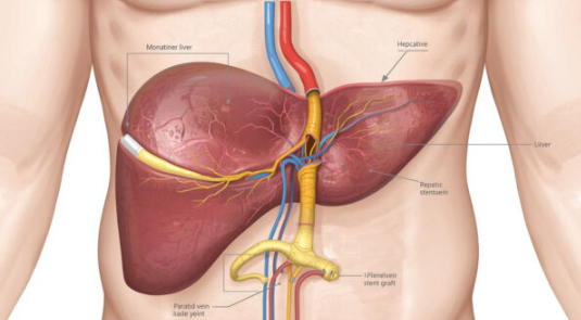 dr-ram-kishore-transjugular-intrahepatic-portosystemic-shunt-hyderabad