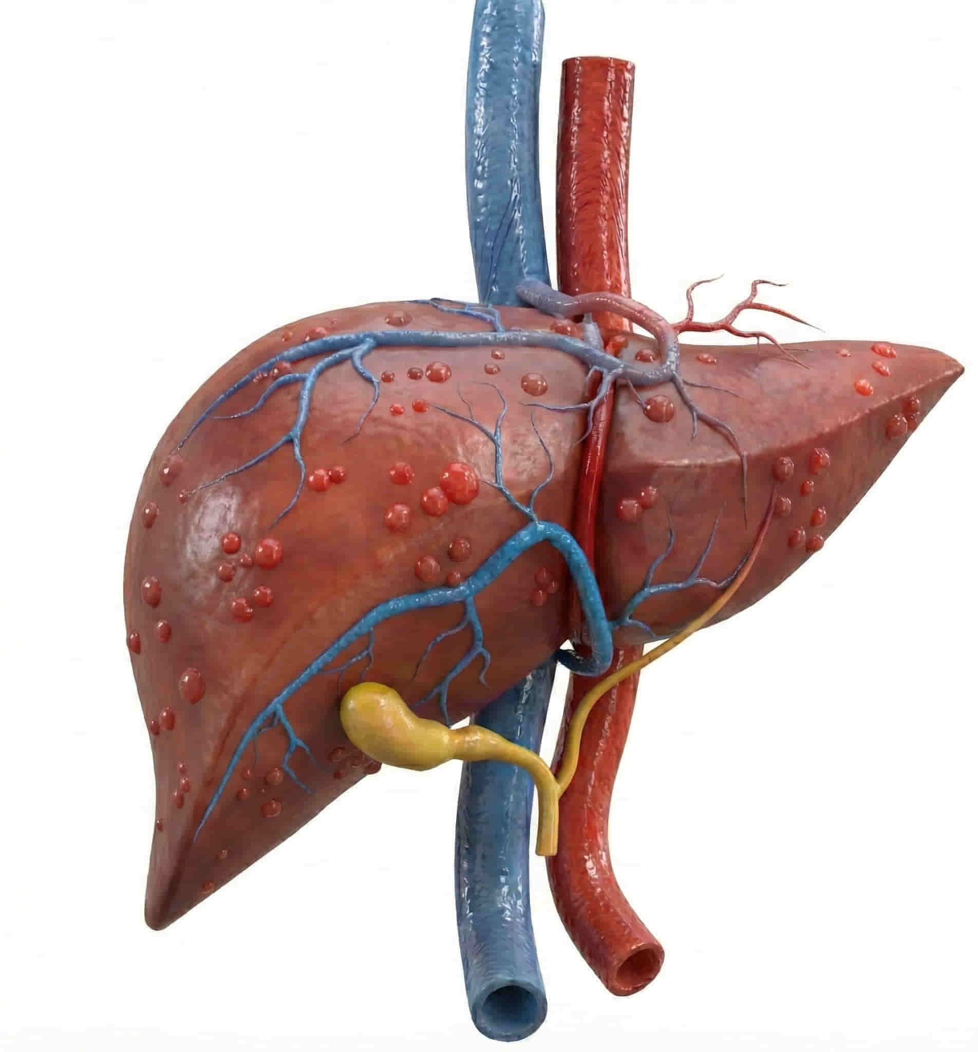 Medical diagram showing the treatment of an infected liver site during transhepatic venous catheterization, managed by Dr. Ram Kishore Gurajala in Hyderabad