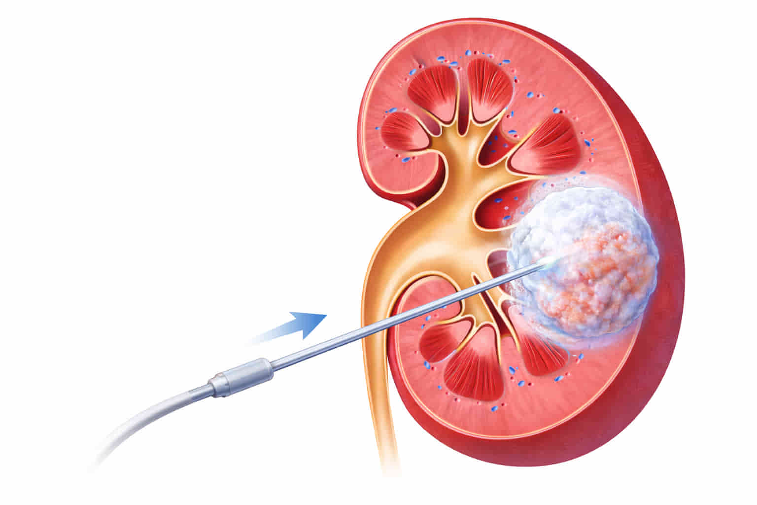 Advanced renal cryoablation treatment for kidney cancer, a minimally invasive procedure performed by expert interventional radiologists in Hyderabad by Dr Ram Kishore Gujarala
