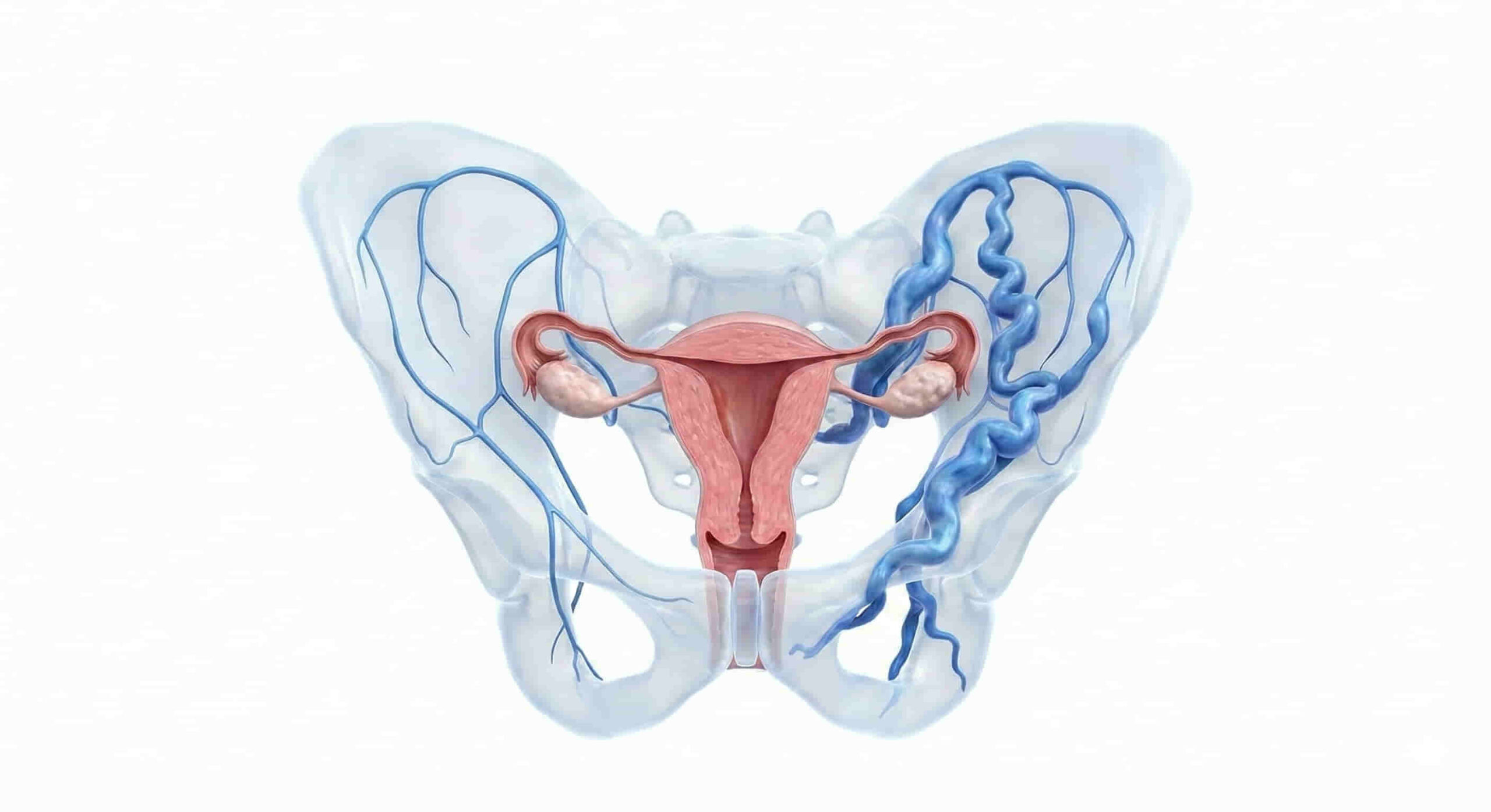 Medical view of the female pelvic region showing dilated ovarian veins, highlighting the area for Ovarian Vein Embolization (OVE) treatment in Hyderabad