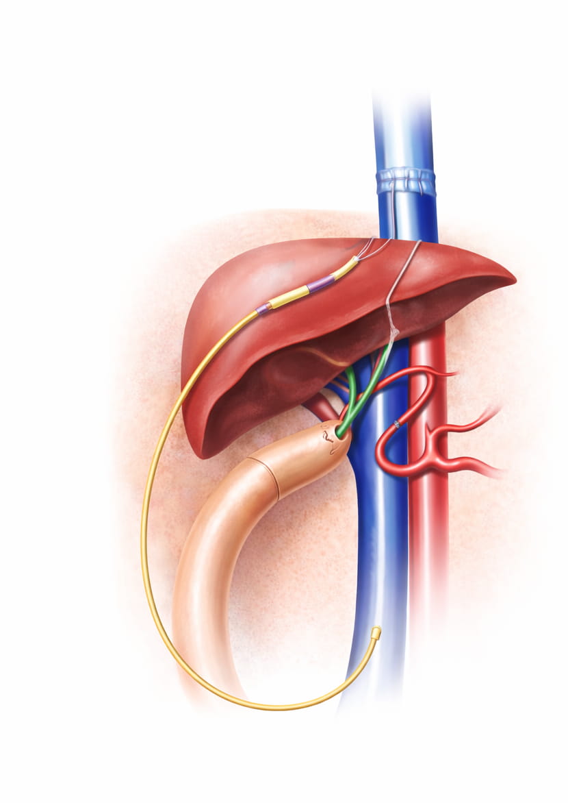 Medical illustration of a transhepatic venous catheter treatment, depicting the insertion of a catheter via the liver to establish central venous access.