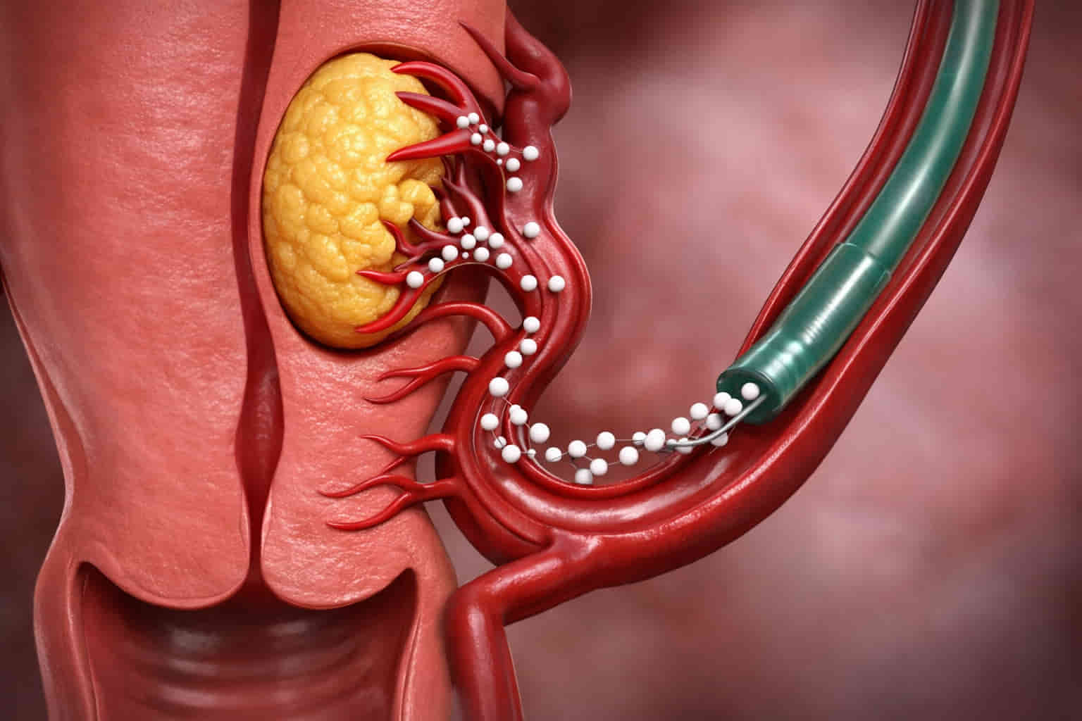 Uterine Fibroid Embolization (UFE) procedure diagram showing how Dr. Ram Kishore blocks blood flow to shrink fibroids at IR4U By Ram, Hyderabad.