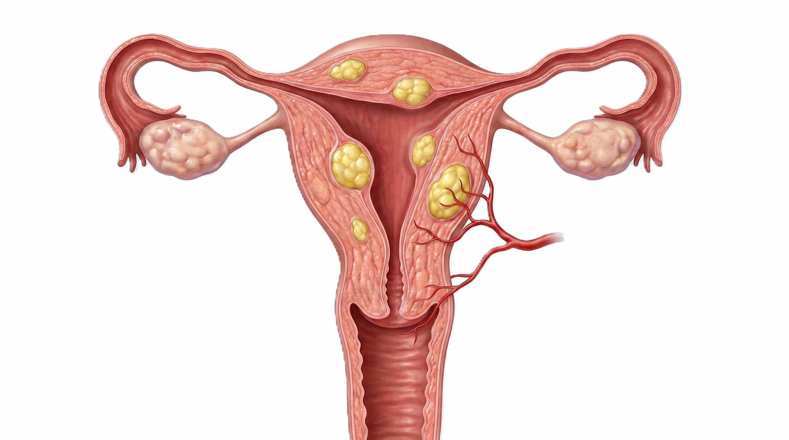 IR4Ubyram Dr Ram Kishore Gujarala Interventional Radiologist India Hyderabad Chennai Uterine Fibroid