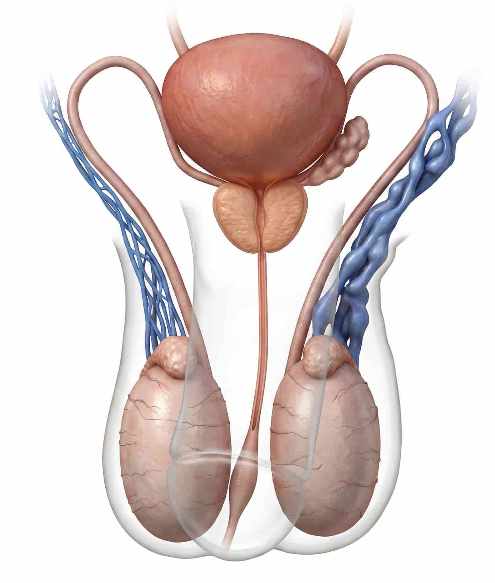 Varicocele embolization anatomy diagram showing how Dr. Ram Kishore treats male infertility and scrotal pain without surgery at IR4U By Ram, Hyderabad.