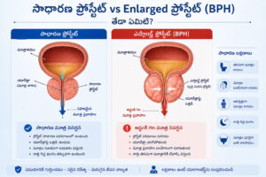 Prostate Artery Embolization (PAE) treatment