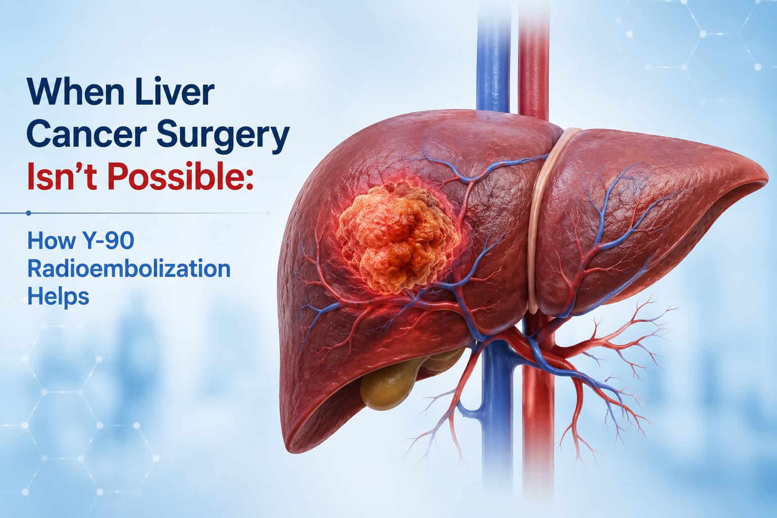Y-90 radioembolization