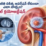 కిడ్నీ కణితి చికిత్స ఆపరేషన్ లేకుండా ఎలా సాధ్యం? రీనల్ క్రయోఅబ్లేషన్